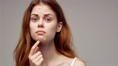 علاج حب الشباب عند البنات.. علاجات متعددة اختاري ما يناسبك