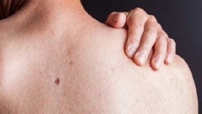 في اليوم العالمى.. متى كان أول ظهور لمرض الإيدز فى العالم؟ ( أرقام مفزعة)