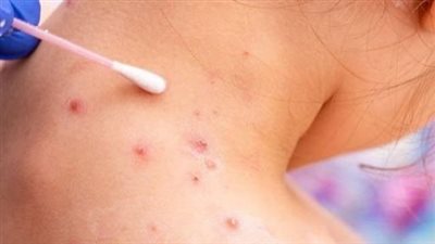 الصحة العالمية: تفشى جدرى القرود بعدد من بلدان العالم منها 11 دولة فى إفريقيا