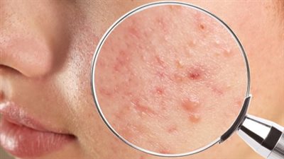 أسباب حب الشباب.. 9 عوامل تؤدي إلى فرط إفراز الدهون