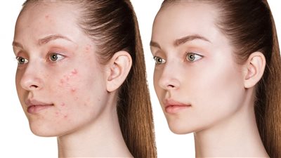 أسباب حب الشباب وعلاجه.. أدوية موضعية وأخرى فموية بالتفصيل