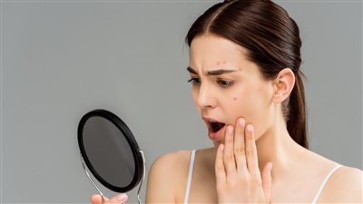 أسباب حب الشباب بعد الثلاثين.. 5 عوامل رئيسية احذريها