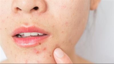 أسباب حب الشباب الهرمونية.. تصيب منطقة الذقن عند البالغين