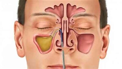 علاج الجيوب الأنفية نهائيا.. ابتعد عن التلوث 